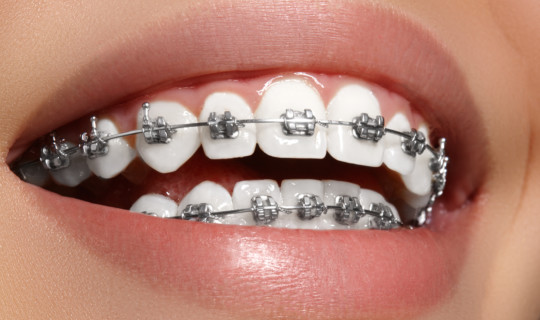 Hábitos de higiene oral en pacientes con ortodoncia