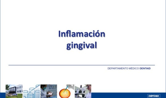 Inflamación gingival