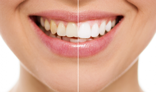 Tipos de blanqueamiento dental y mantenimiento